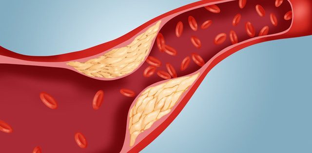 Understand Cholesterol Once and For All (LDL vs. HDL)